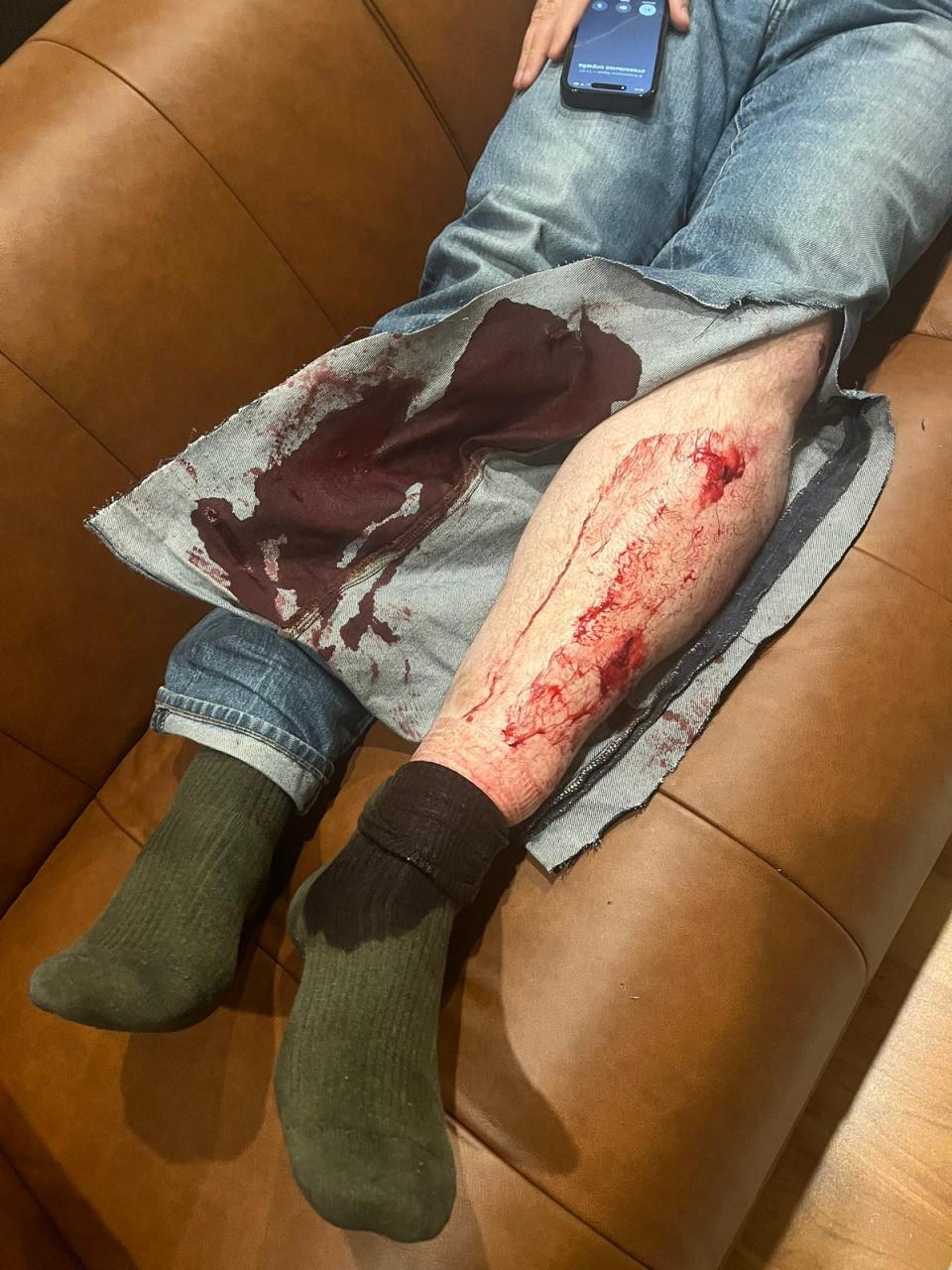 Leonid Volkov's wounds after he was attacked outside his home in Vilnius (Courtesy of X user @a_biryukova/)