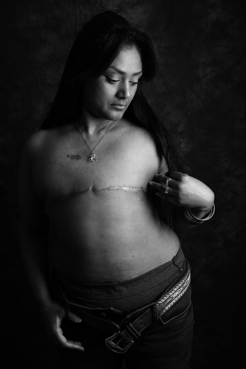 One of sixteen men and women who have bared their scars as part of a project called 'Defiance'.