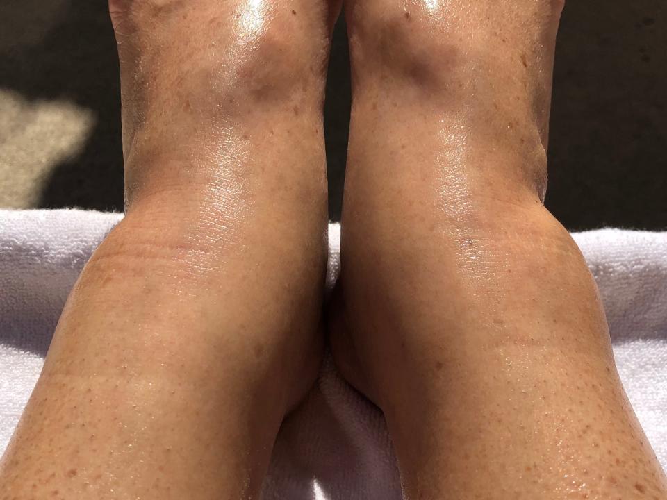 swollen ankles