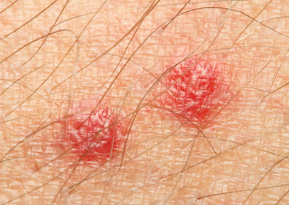 Un petit point rouge ou une bosse élevée sur la peau peut-être un signe de piqure de punaise de lit. (Crédit : Getty Images/iStockphoto)