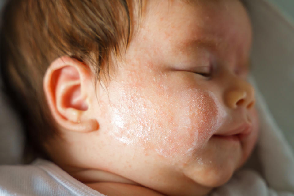Eczema is thought to cause a 'crack' in the skin barrier, which therefore may expose a baby to allergens. (Getty Images)