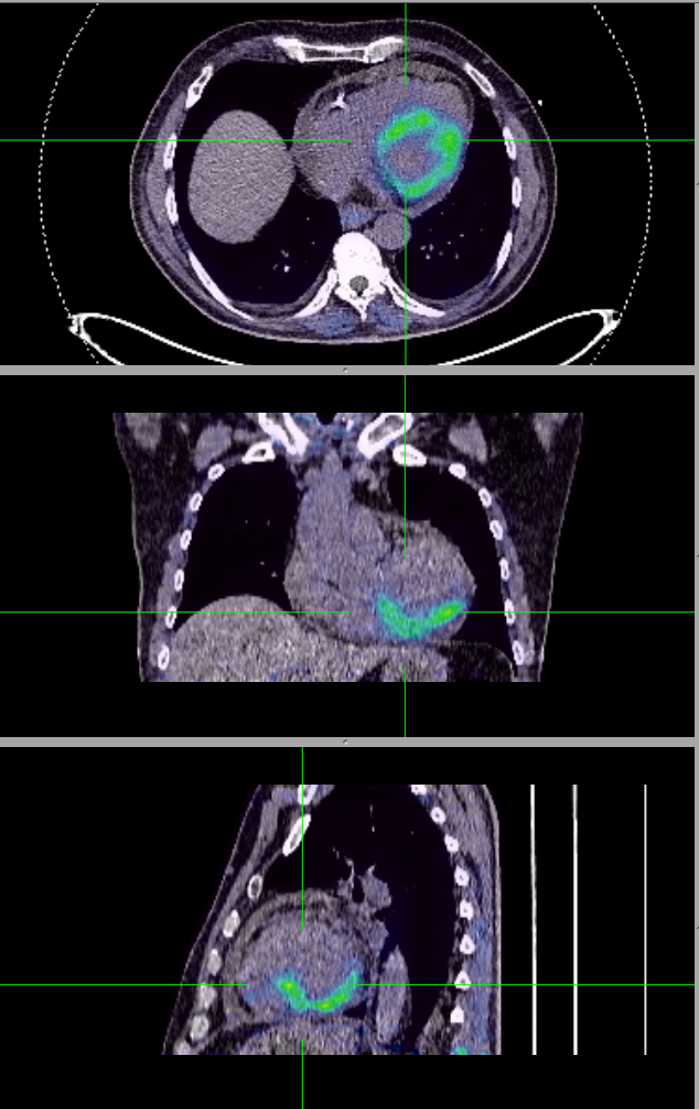 A PET scan shows the scar tissue in a heart after a heart attack. It's this scar tissue that a new approach developed at the University of Pennsylvania aims to treat.