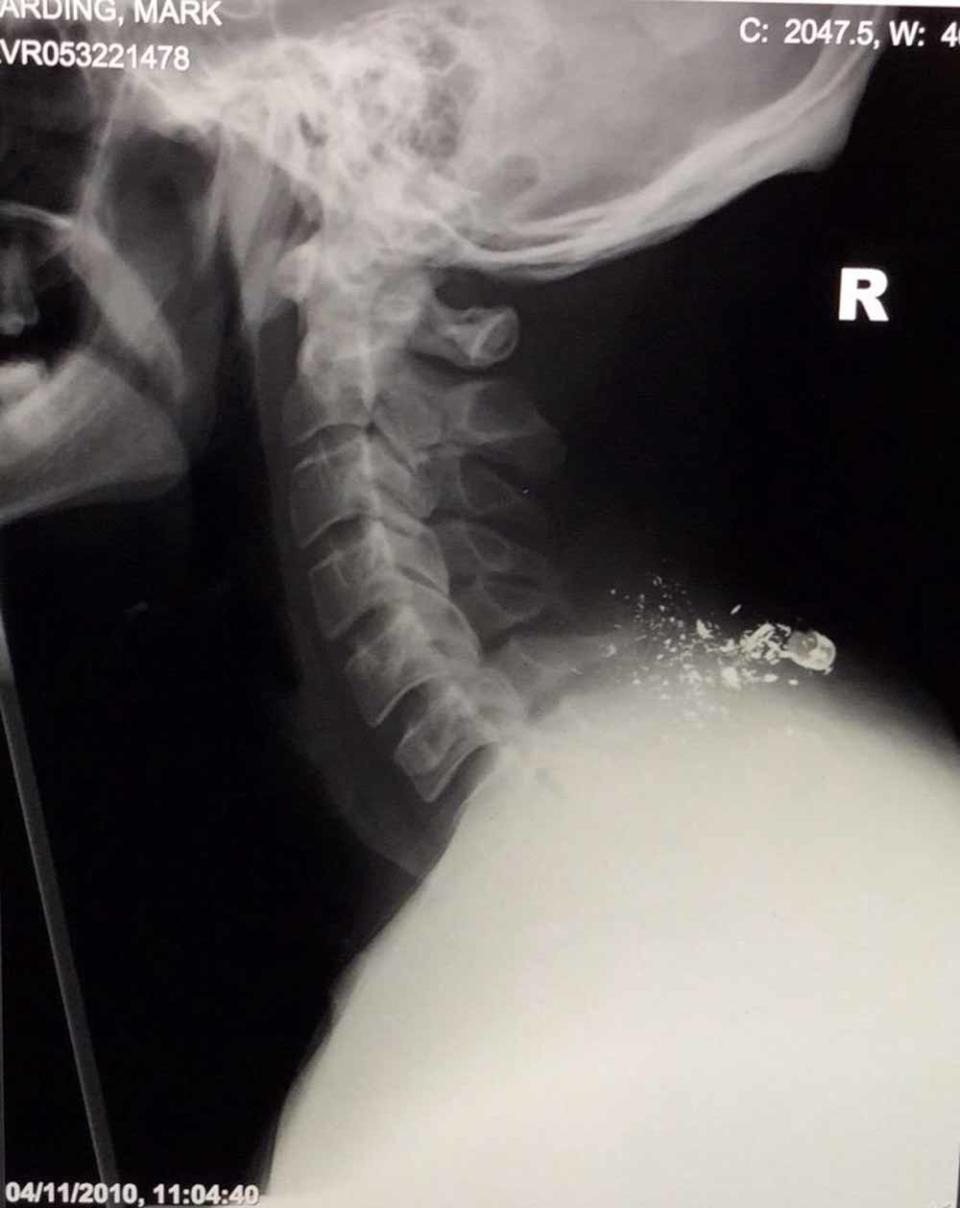 The shooting damaged Mark’s spinal cord. (Collect/PA Real Life)