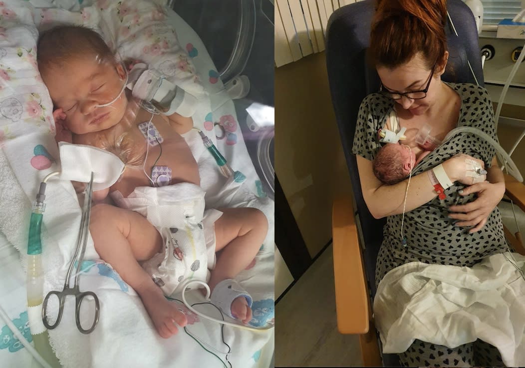 A baby whose lungs collapsed from crying has beaten the odds to survive. (SWNS)
