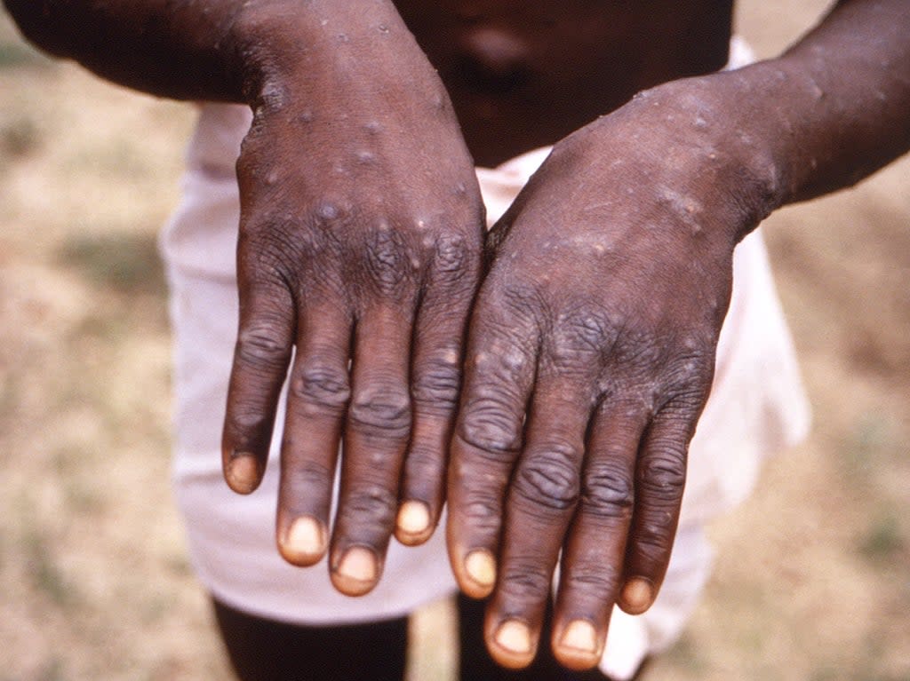 Monkeypox continues to spread across the globe (Brian W J Mahyvia/CDC/Reuters)