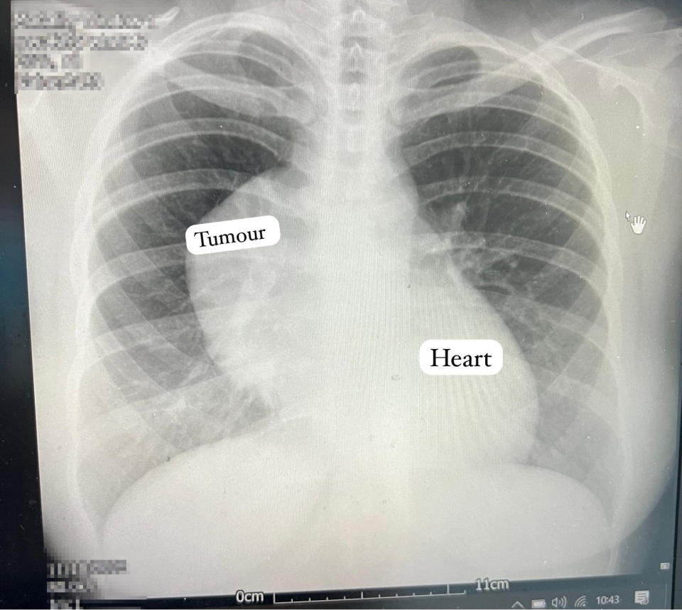 Plastiras' chest X-ray revealed a 12cm tumour. (Joe Bird/SWNS)