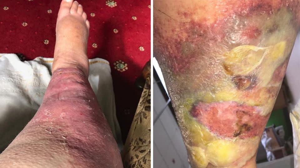 The account executive from Bingley, West Yorkshire, was left with an inflamed red-raw leg covered in pus-filled boils. Source: SWNS