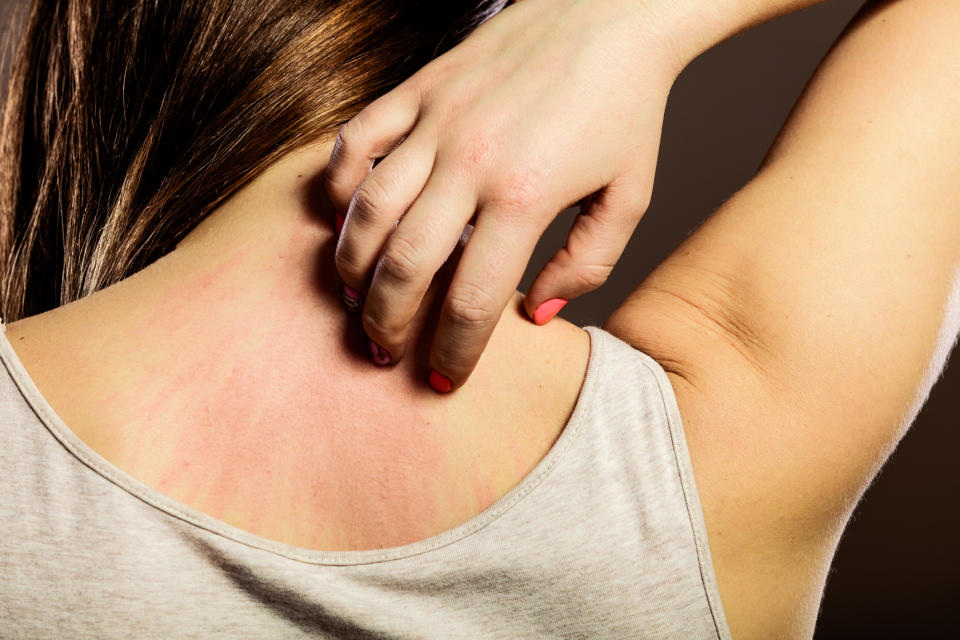 Woman with itchy skin, a lesser-known symptom of the menopause. (Getty Images)