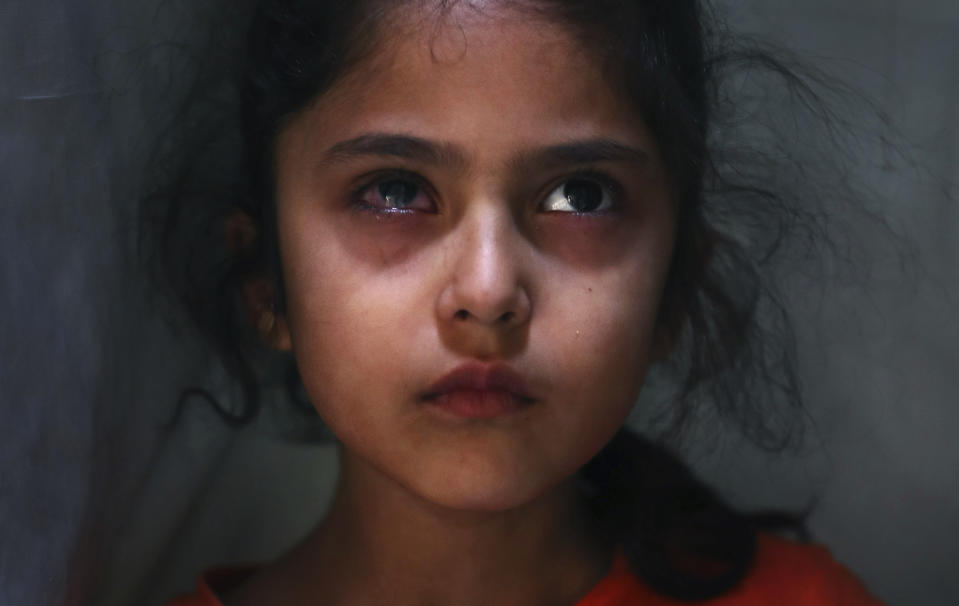 Six-year-old Muneefa Nazir, a Kashmiri girl whose right eye was hit by a marble ball, stands outside her home in Srinagar on Sept. 17, 2019. (AP Photo/Mukhtar Khan)