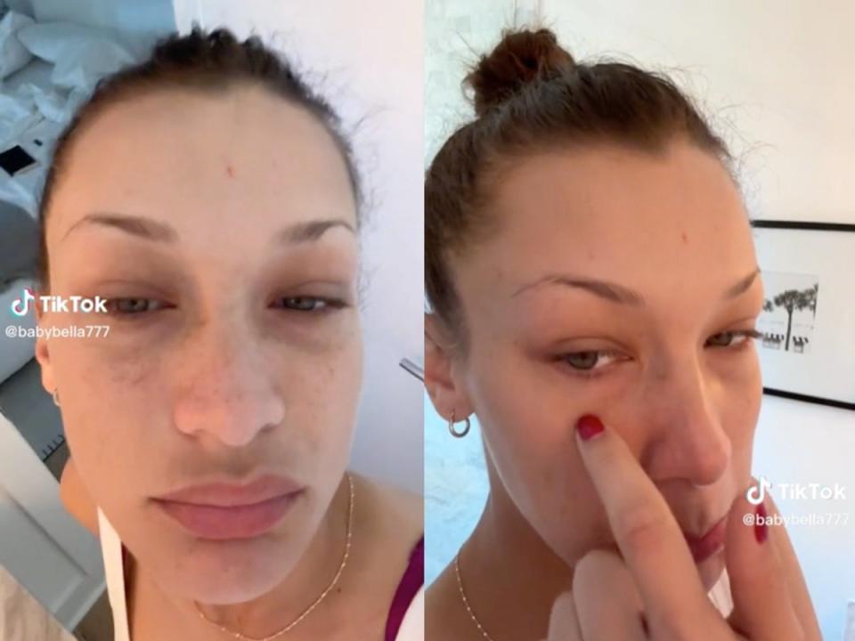 Bella Hadid shows off inflammation due to Lyme disease flare up (TikTok/Bella Hadid)