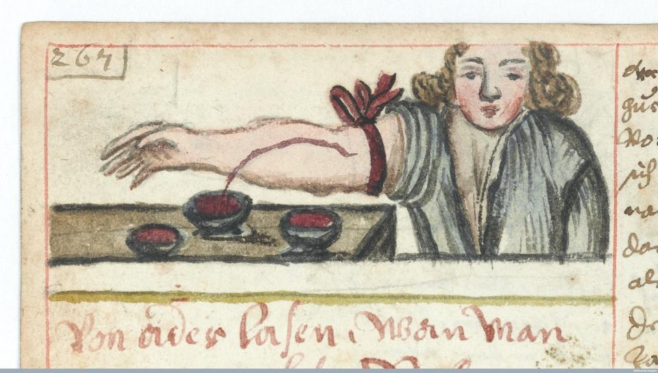 Man wears a tourniquet, letting blood into a bowl. Two other bowls already filled with blood sit nearby. (Circa 1675)