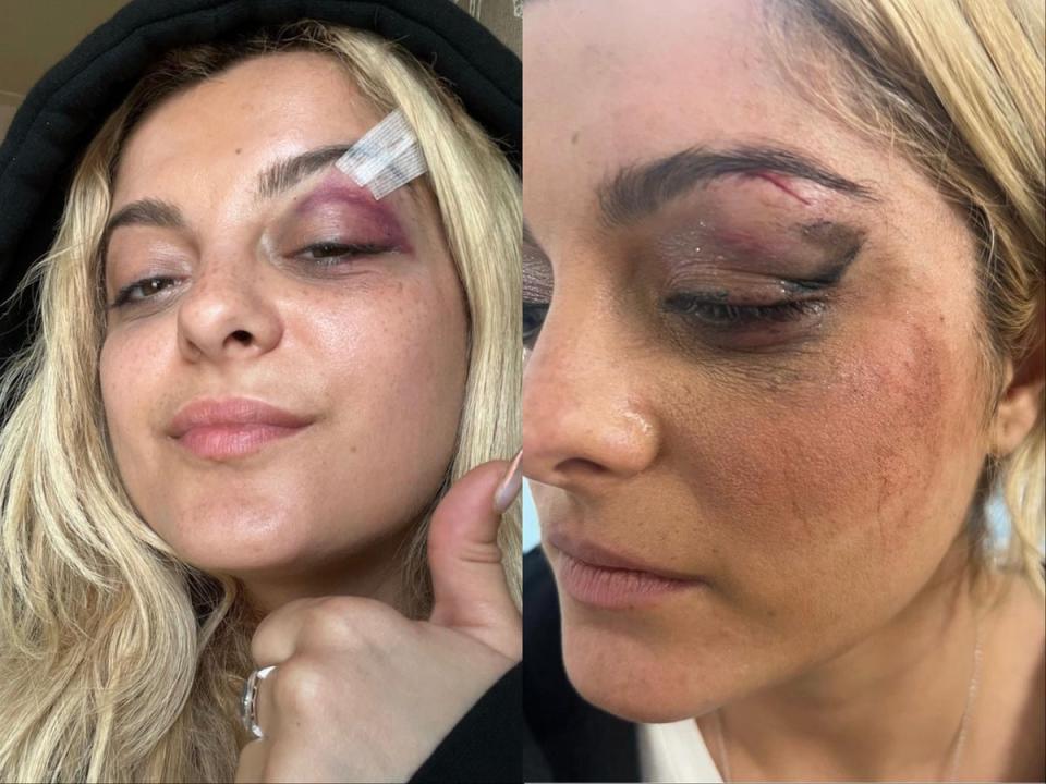 Bebe Rexha received stitches above her left eye after a fan threw their phone at her on stage in 2023 (Bebe Rexha/Instagram)