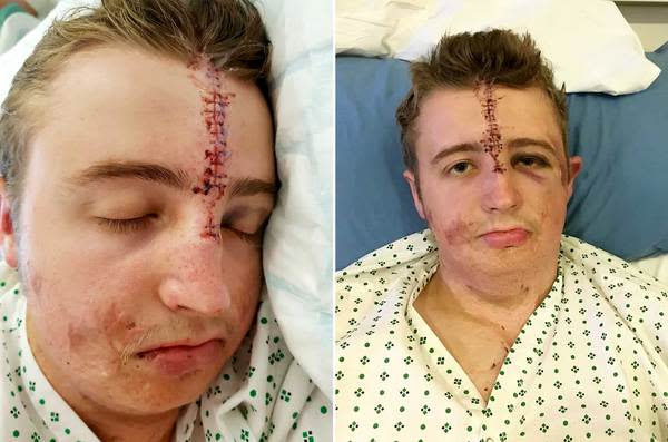 Frank Richardson, 21, was waiting for a train when the heavy wrought iron security gates flung open and smashed him in the face. (SWNS) 