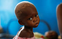 Ntumbabu Kalubi, 4, an internally displaced and severely acute malnourished child waits to receive medical attention at the Tshiamala general referral hospital of Mwene Ditu in Kasai Oriental Province in the Democratic Republic of Congo, March 15, 2018. Picture taken March 15, 2018. REUTERS/Thomas Mukoya