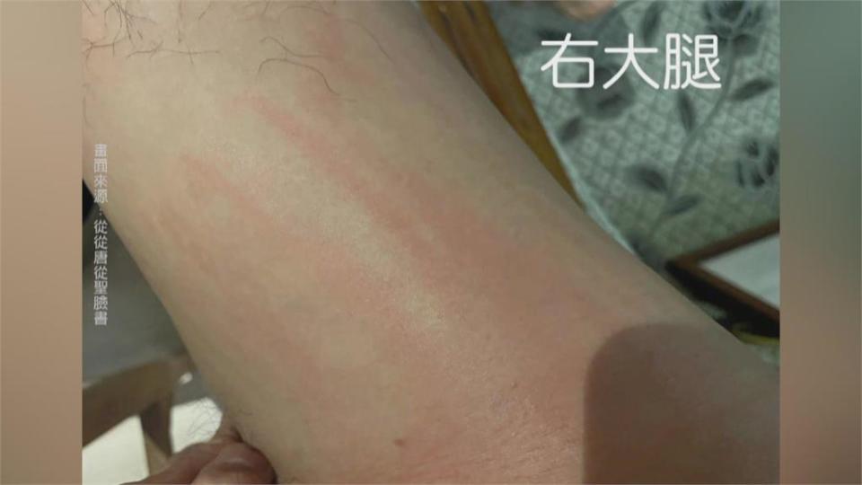 手臂、大腿佈滿紅色抓痕　唐從聖打AZ爆全身發癢