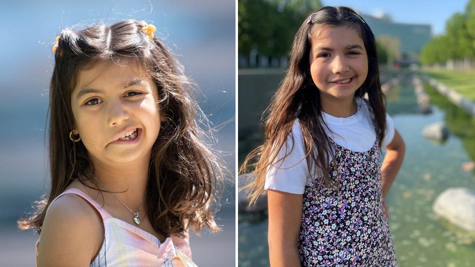 Nicole Serna-Gonzalez, an 11-year-old who at birth was diagnosed with unilateral congenital facial paralysis, making it impossible for her to smile using the right side of her face. In June 2021, Nicole underwent a 10-hour facial reanimation surgery and has shown improvement.