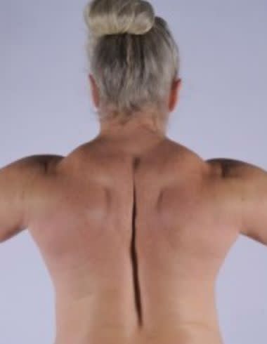 The author's back and shoulders in 2009, two years after her muscles began growing rapidly. (Photo: Courtesy of Sally Massagee)