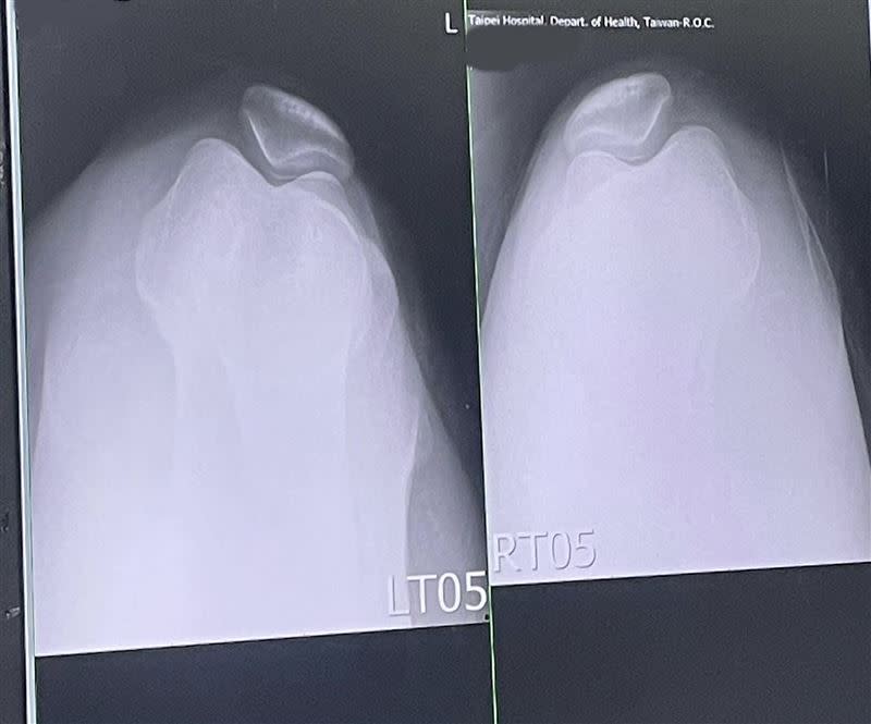 常感到膝蓋卡卡不順與疼痛感，原來是雙膝髕骨外翻。（圖／台北醫院提供）