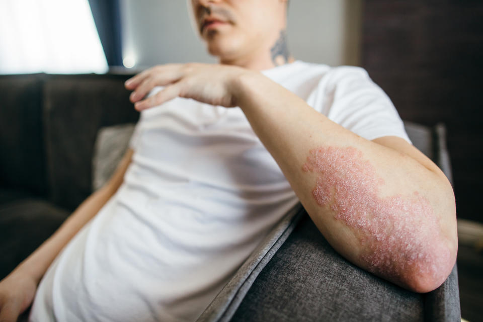 Close-up of the peeling skin of a man on his hands with eczema, psoriasis and other skin diseases such as fungus, plaque, rash and spots. Autoimmune genetic disease.