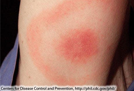 An image of a Lyme disease symptom provided by the Centers for Disease Control and Prevention.