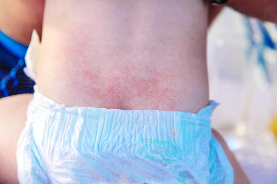 heat rash (Alamy )