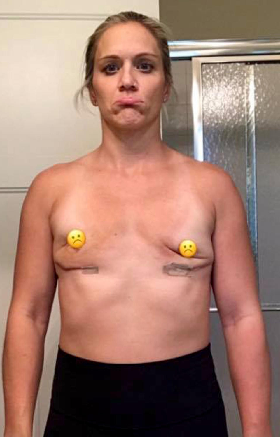 Andrea is now left with little to no scar tissue and deformed breasts but for the sake of her health she says it was worth it. Source: Caters News