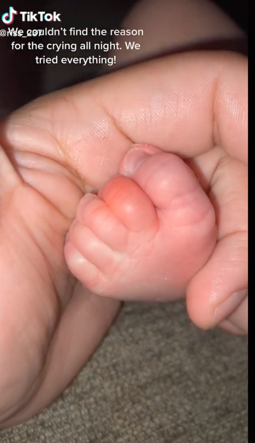 Woman finds hair on baby&#39;s toe