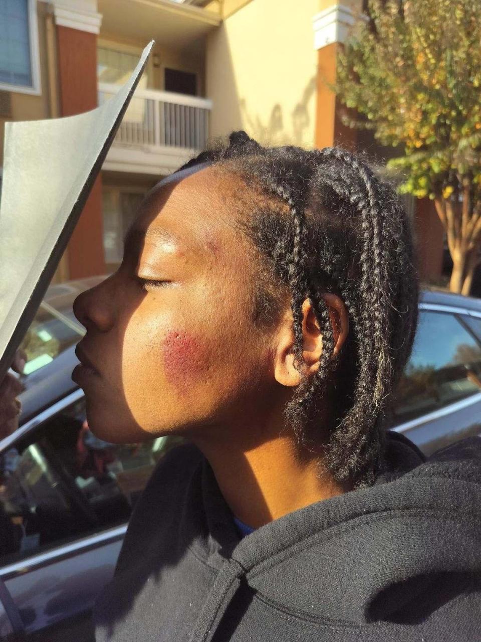 A photo provided by Team Trublue founder Will Adams shows marks on one side of Christina Pierre’s face. An officer struck her in the face, police confirmed Thursday.