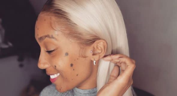 A mum who was bullied for the moles that cover her body has been signed to a modelling agency [Image: Instagram]