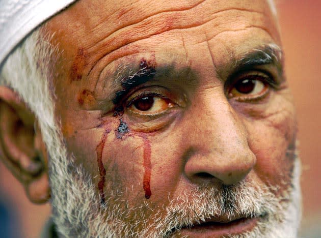 Kashmiri Ghulam Mohammed Matta looks on after he was beaten by police during a demonstration in Srinagar, India, Tuesday, Nov. 21, 2006. Hundreds of Muslims shouted slogans against the government after they were denied travel permits for the annual Haj pilgrimage, reportedly because of an administrative miscommunication. (AP Photo/Rafiq Maqbool)