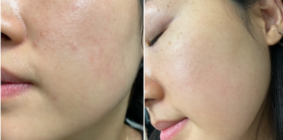 Before skin cycling, I often dealt with patches of redness, along with occasional breakouts and bumps. Now, my skin texture is much smoother and the redness has gone down.