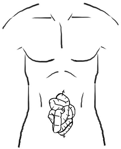 An illustration of the initial abdominal examination after a man presented with an exposed bowel. American Journal of Medical Case Reports