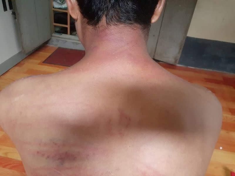 A man, who says he was beaten by soldiers in custody, shows his bruises in Myeik