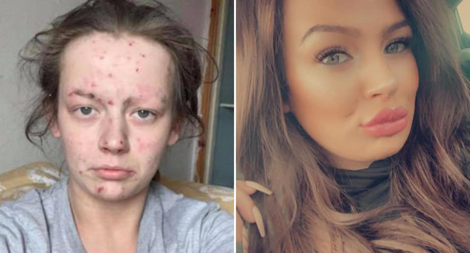 Demi-Nicole Dunlop, 27, before and after her heroin addiction.