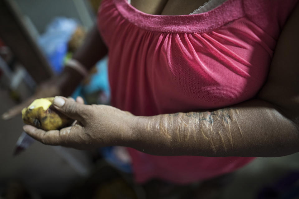 In this April 5, 2020 photo, Carmen Rosa de la Cruz, whose arm is scarred from self-harm, peels potatoes as she prepares a soup inside the deteriorating building nicknamed “Luriganchito” after the country’s most populous prison, in Lima, Peru, during a nationwide lockdown to help contain the spread of the new coronavirus. (AP Photo/Rodrigo Abd)