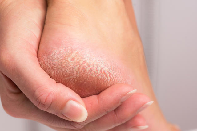 How to Remove Calluses