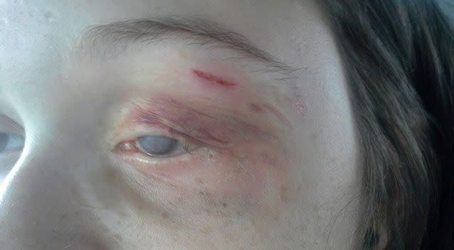 The 18-year-old-girl, who is partially blind and deaf in one ear, was left bleeding from the face when she was detailed by airport security. Picture: Supplied