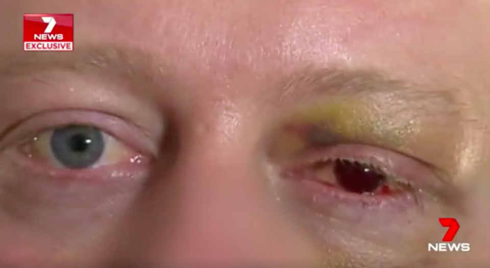 Adam may be forced to have his left eye removed following the alleged attack. Source: 7News