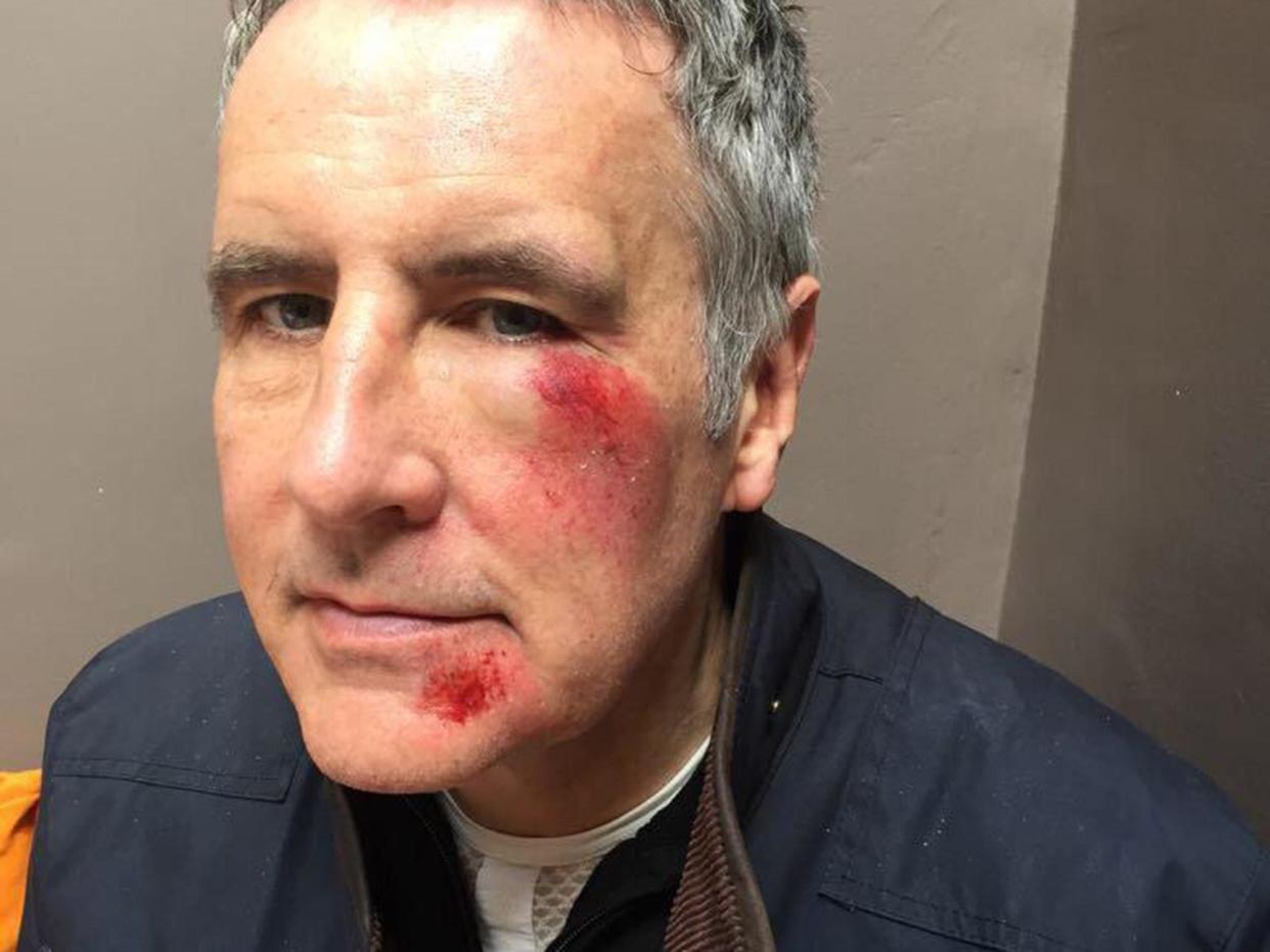 The Sky presenter was left with injuries to the left side of his cheek and chin: Dermot Murnaghan/Twitter