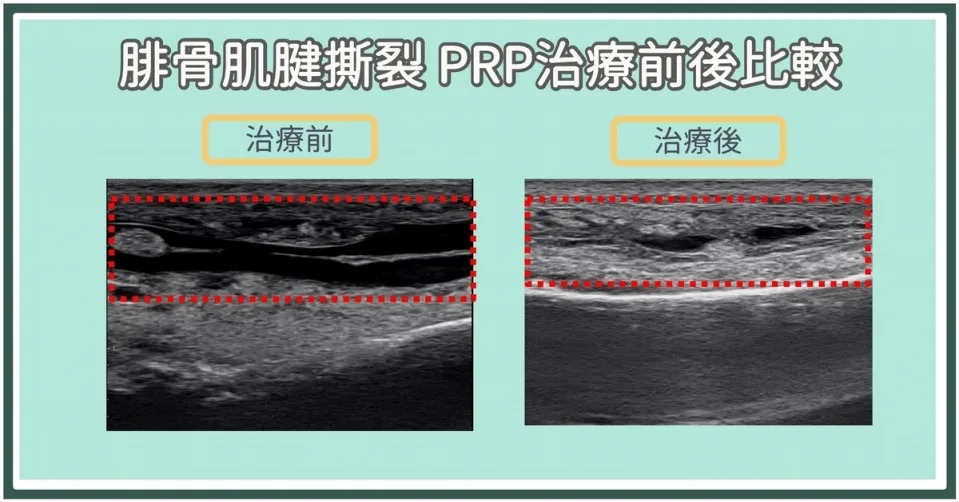 腓骨肌腱炎、撕裂、脫位如何治療？