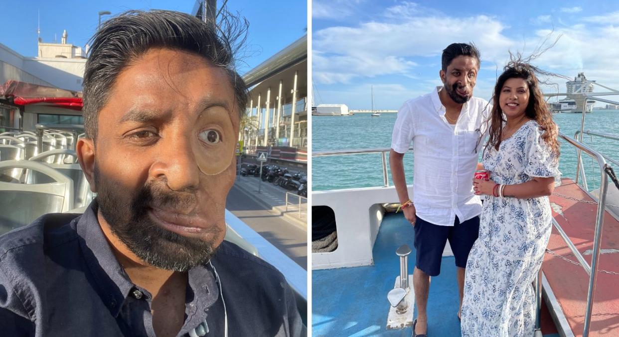 Amit Ghose has a facial disfigurement, after being born with neurofibromatosis type 1, a condition that causes tumours to grow along nerves. (Amit Ghose/SWNS)