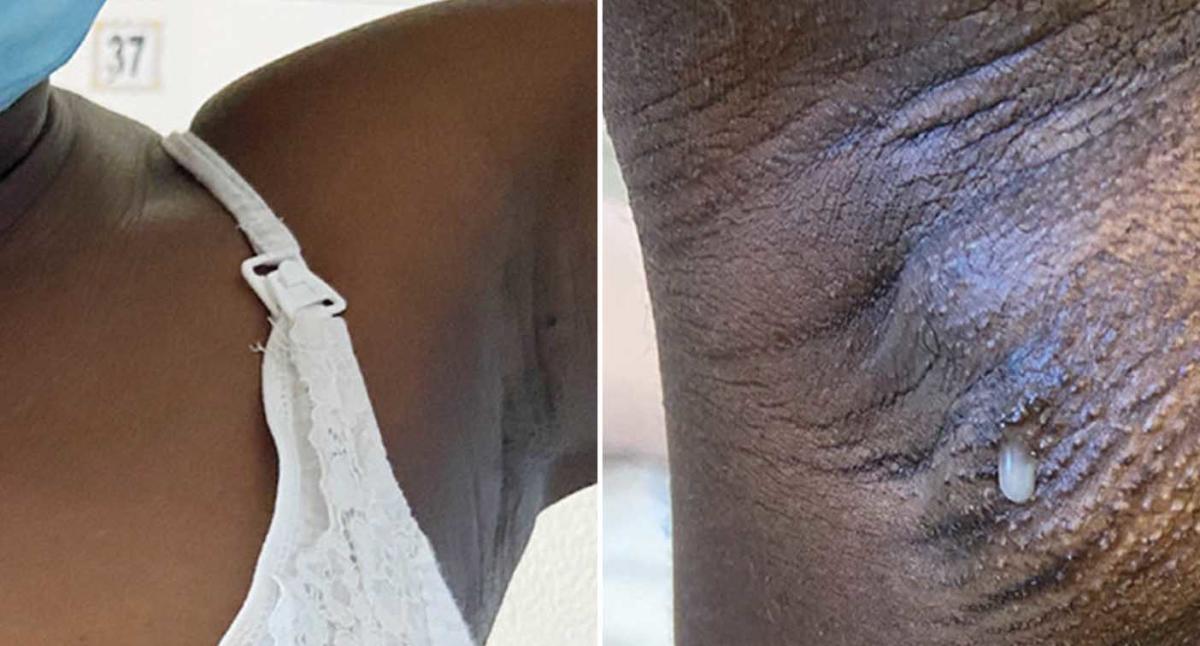 22-year-old mother develops milk-producing 'breast' in armpit