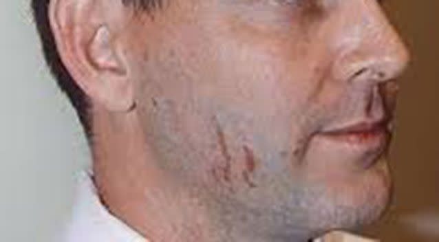 The scratches that appeared on Baden-Clay's face. Source: Supplied.