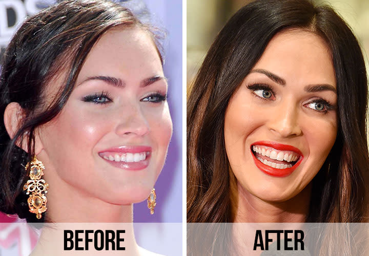 Celebrity Dental Implants And Veneers Before And After