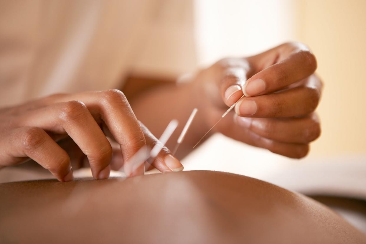 person receiving acupuncture