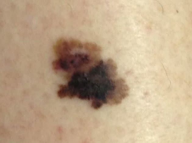 This is what melanoma can look like.