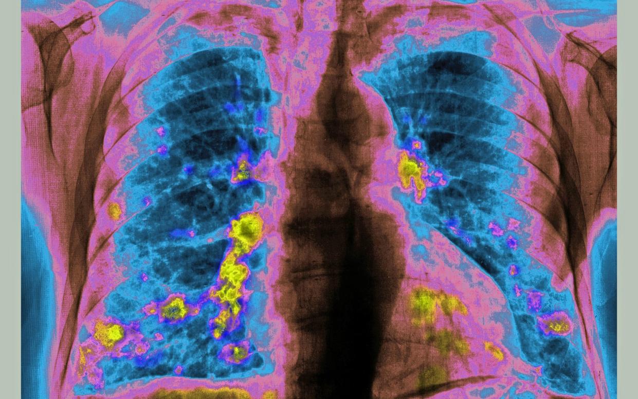 The new drug acts as an off switch for lung cancer - BSIP