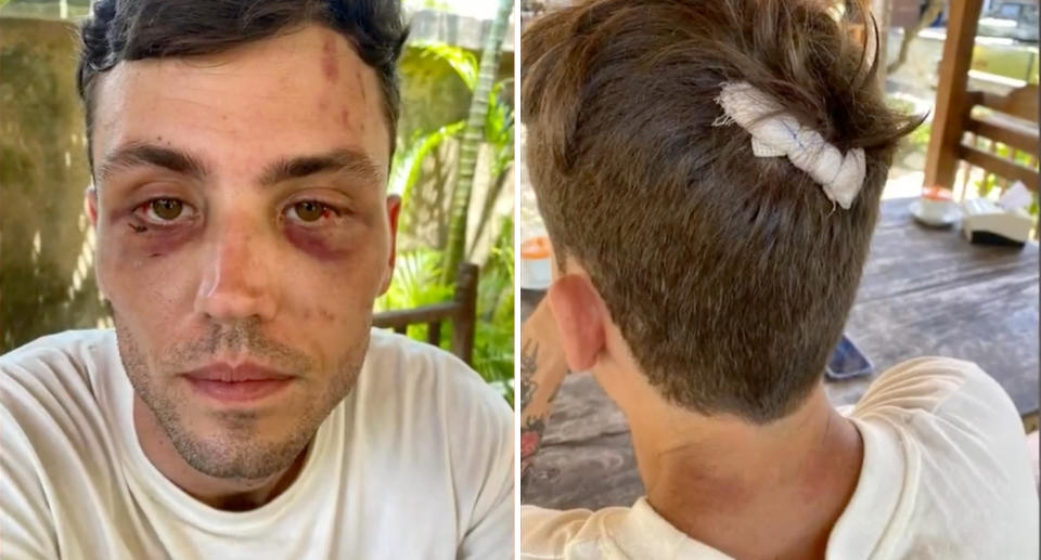 Matthew Stevenson facial injuries after being bashed in Bali. 