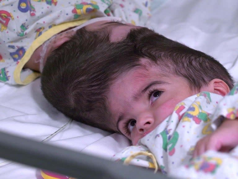 Rare conjoined twins connected by their skulls have been separated after 50 hours of operations at a London hospital.Two-year-old sisters Safa and Marwa Ullah had to undergo three major operations at Great Ormond Street Hospital (GOSH) to separate their heads.The first operation took place in October 2018, when the girls, from Charsadda, in Pakistan, were just 19 months old.They were finally separated during their last operation on 11 February this year.The girls’ mother, Zainab Bibi, 34, who has previously had seven children, said: “We are indebted to the hospital and to the staff, and we would like to thank them for everything they have done.“We are extremely excited about the future.”The girls, whose father died of a heart attack while their mother was pregnant with them, were discharged from hospital on 1 July.They have now moved to an address in London with their mother, grandfather Mohammad Sadat Hussain, 57, and uncle, Mohammad Idrees.The girls, who were born by caesarean section, were craniopagus twins, meaning their skulls and blood vessels were fused together.GOSH had previously successfully separated craniopagus twins in 2006 and 2011.Experts used virtual reality to create an exact replica of the girls’ anatomy so that they could visualise the structure of their skulls as well as the positioning of their brains and blood vessels.A team also used 3D printing to create plastic models of the structures that could be used for practice, as well as cutting guides.During the surgery, doctors first worked to separate the girls’ blood vessels and then inserted a piece of plastic into their heads to keep the brains and blood vessels apart.The final major operation involved medics building new skulls using the girls’ own bone.The surgery, which was paid for by Pakistani businessman Murtaza Lakhani, has been followed by several smaller procedures which will enable the girls to live independent lives.The operations added up to more than 50 hours of surgery time and involved 100 members of staff from GOSH.Neurosurgeon Noor ul Owase Jeelani and craniofacial surgeon Professor David Dunaway led the team that operated on the girls.Mr Jeelani, a neurosurgeon at GOSH, and Professor Dunaway, head of the hospital’s craniofacial unit, said: “We are delighted we have been able to help Safa and Marwa and their family.“It has been a long and complex journey for them, and for the clinical team looking after them.“Their faith and determination have been so important in getting them through the challenges they have faced. We are incredibly proud of them.“We are also incredibly proud of the GOSH team responsible for their treatment and care over the past 10 months.”Conjoined twins are very rare – affecting only about one in every 2.5 million births.Press Association contributed to this report.