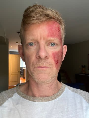 <p>Jamie Campbell/X</p> Jamie Campbell shows results of his pre-skin cancer treatment to Twitter